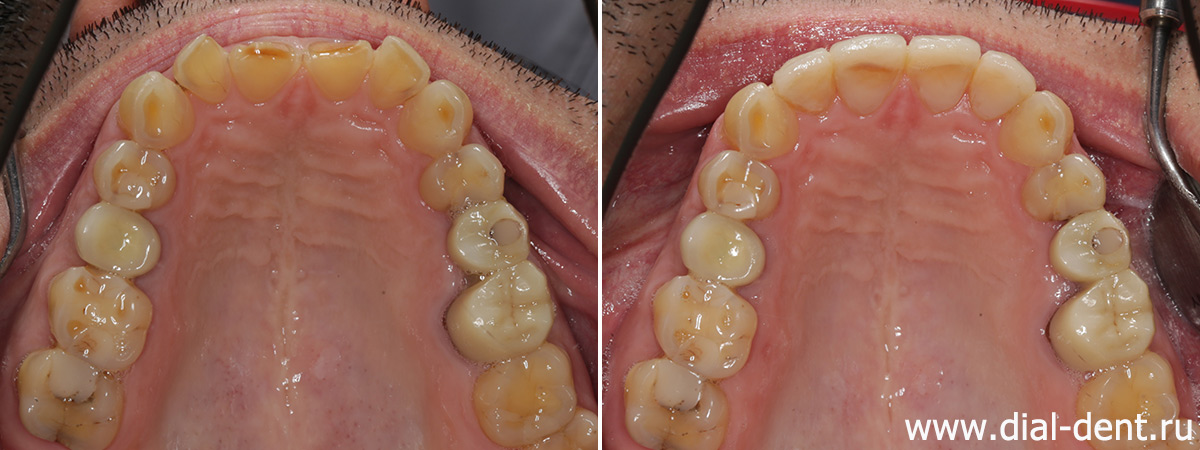 до и после художественной реставрации 4-х передних верхних зубов