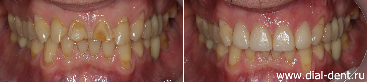 вид зубов до и после художественной реставрации