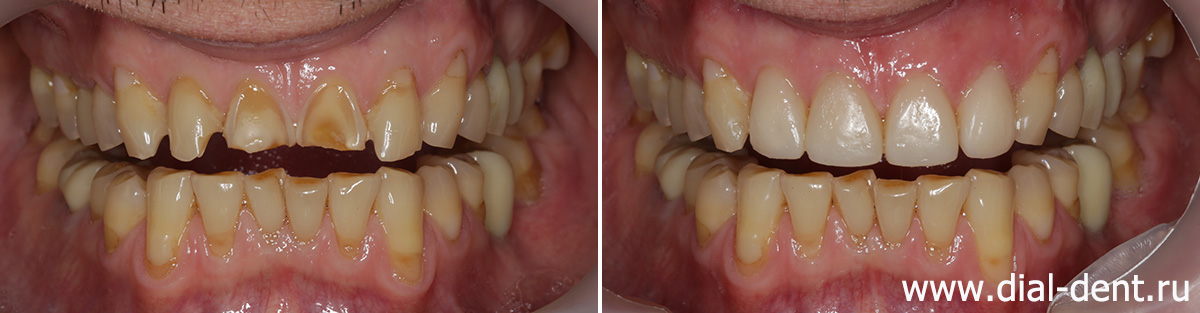 до и после художественной реставрации 4-х передних верхних зубов