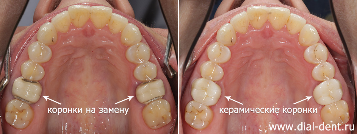 Замена коронок на 2-х зубах после ортодонтического лечения