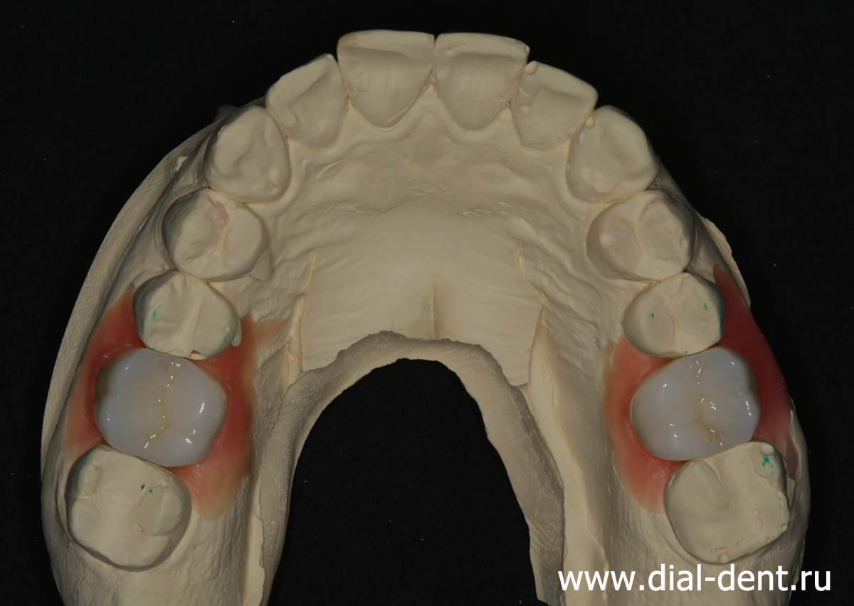 керамические коронки зубов на модели в лаборатории Диал-Дент
