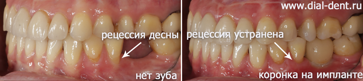 вид зубов слева до и после протезирования на импланте