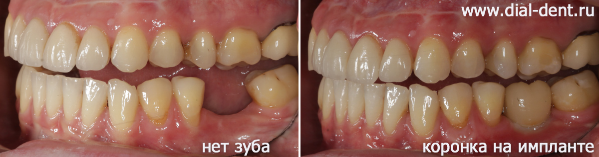 вид зубов слева до и после протезирования на импланте
