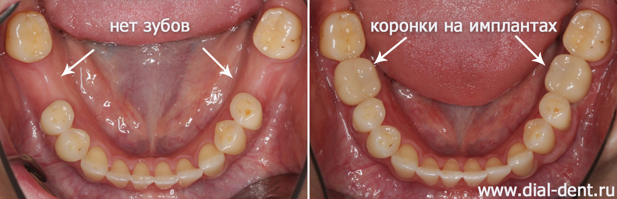 нижние зубы до и после протезирования на имплантах