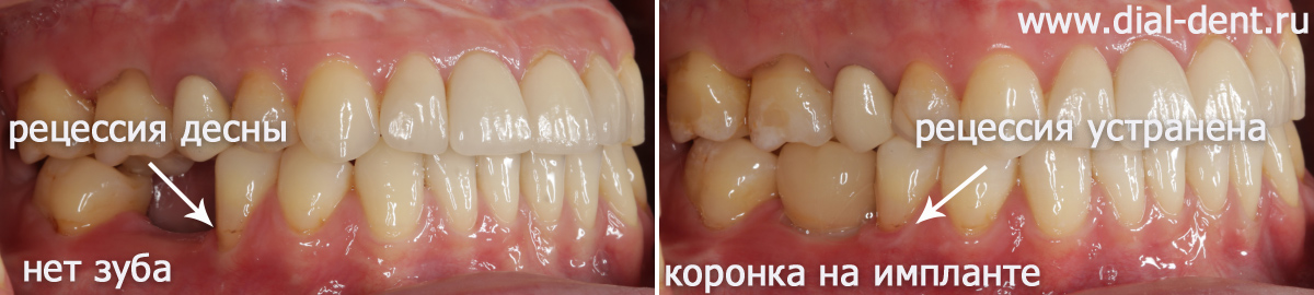 вид зубов справа до и после протезирования на импланте