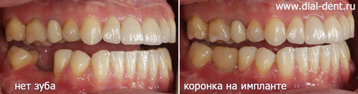 вид зубов справа до и после протезирования на импланте