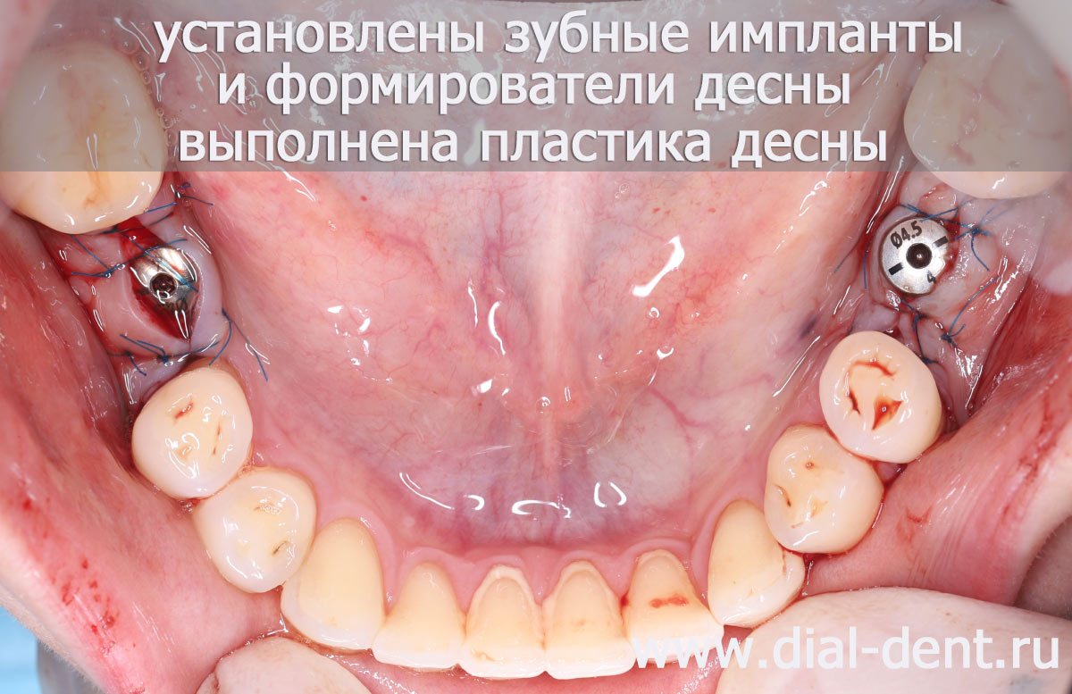вид после операции по установке зубных имплантов и пластики десны