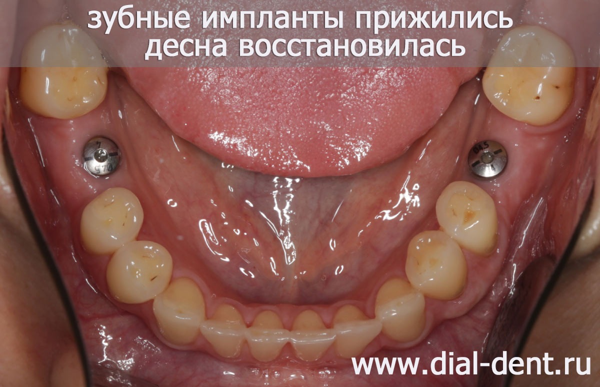вид перед протезированием зубов