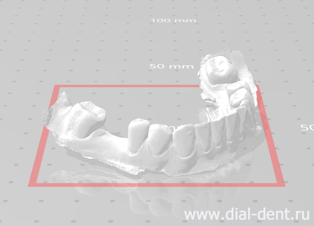 сканирование зубов - цифровой слепок без слепочной массы