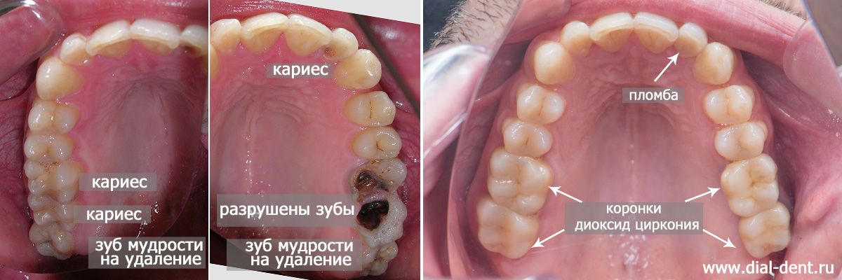 зубы до и после лечения