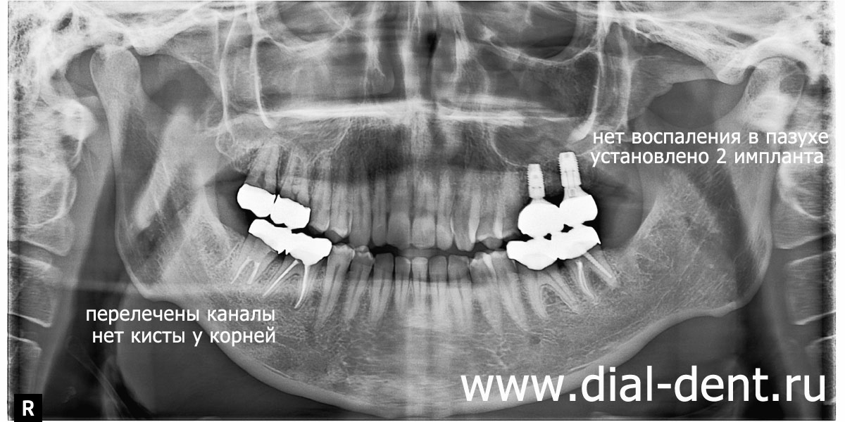 панорамный рентген зубов