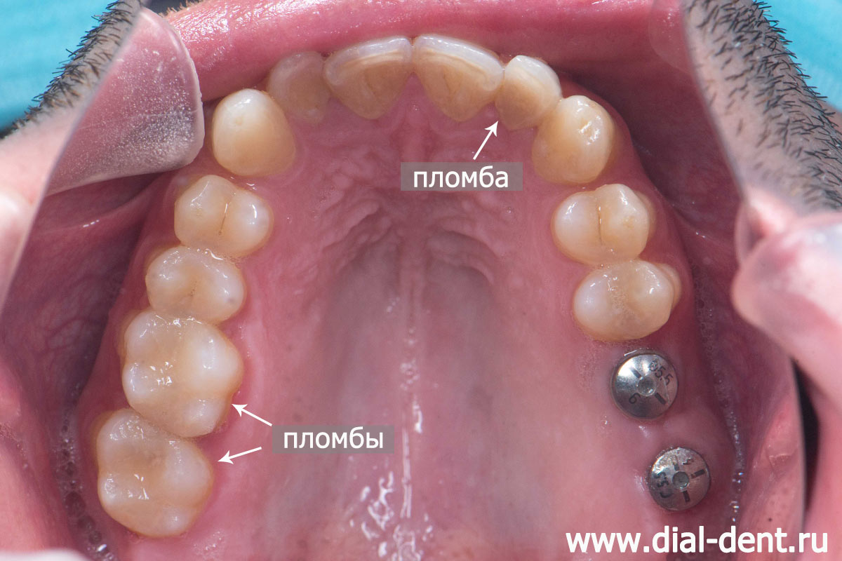 верхние зубы, пломбы, зубные импланты