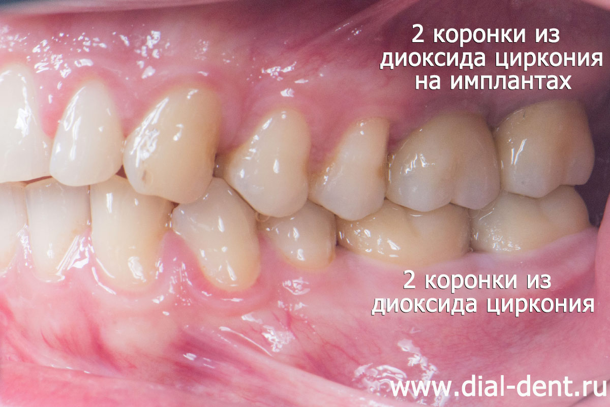 зубы с коронками на имплантах