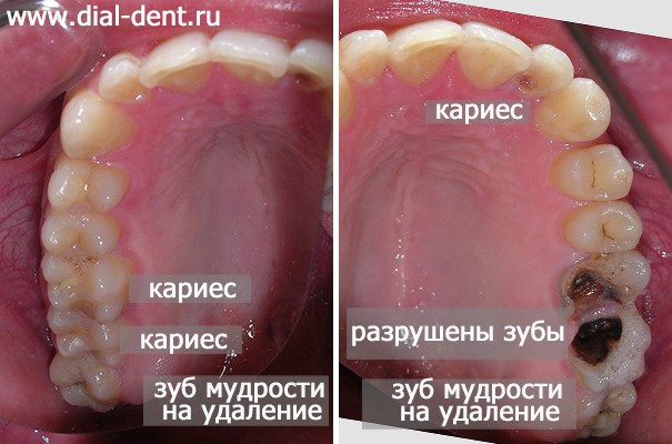 кариес, разрушенные зубы