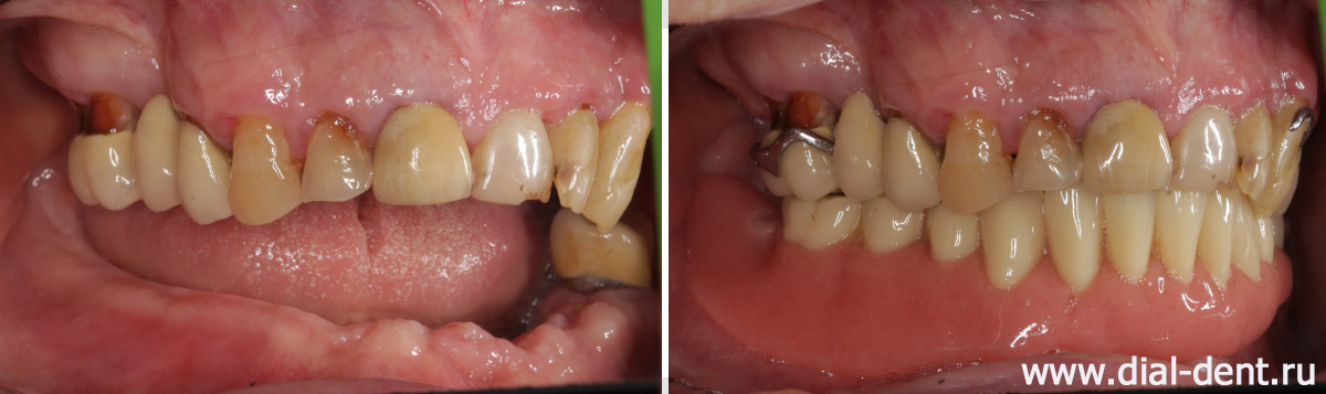 вид справа до и после протезирования зубов