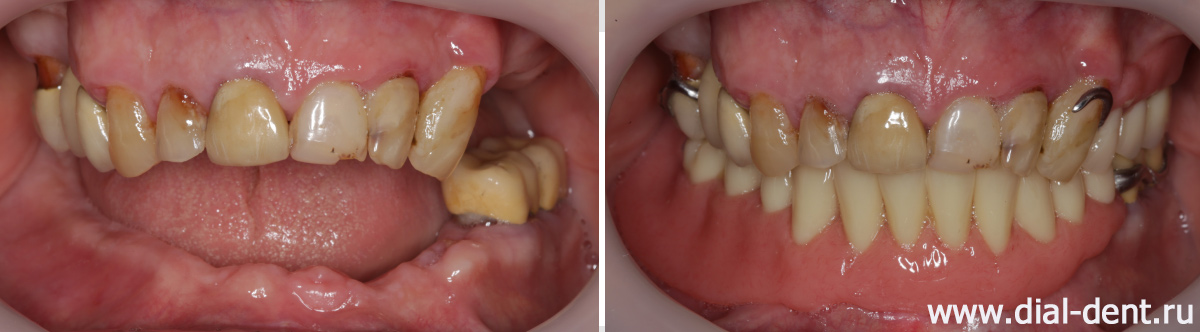 вид до и после протезирования зубов