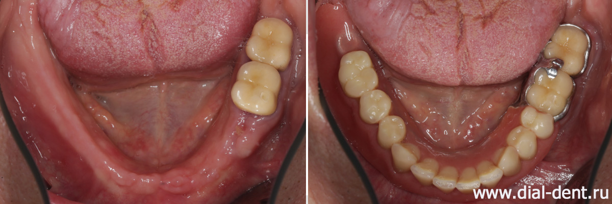 бюгельный зубной протез для нижней челюсти