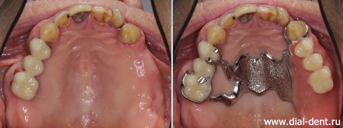 бюгельный зубной протез для верхней челюсти
