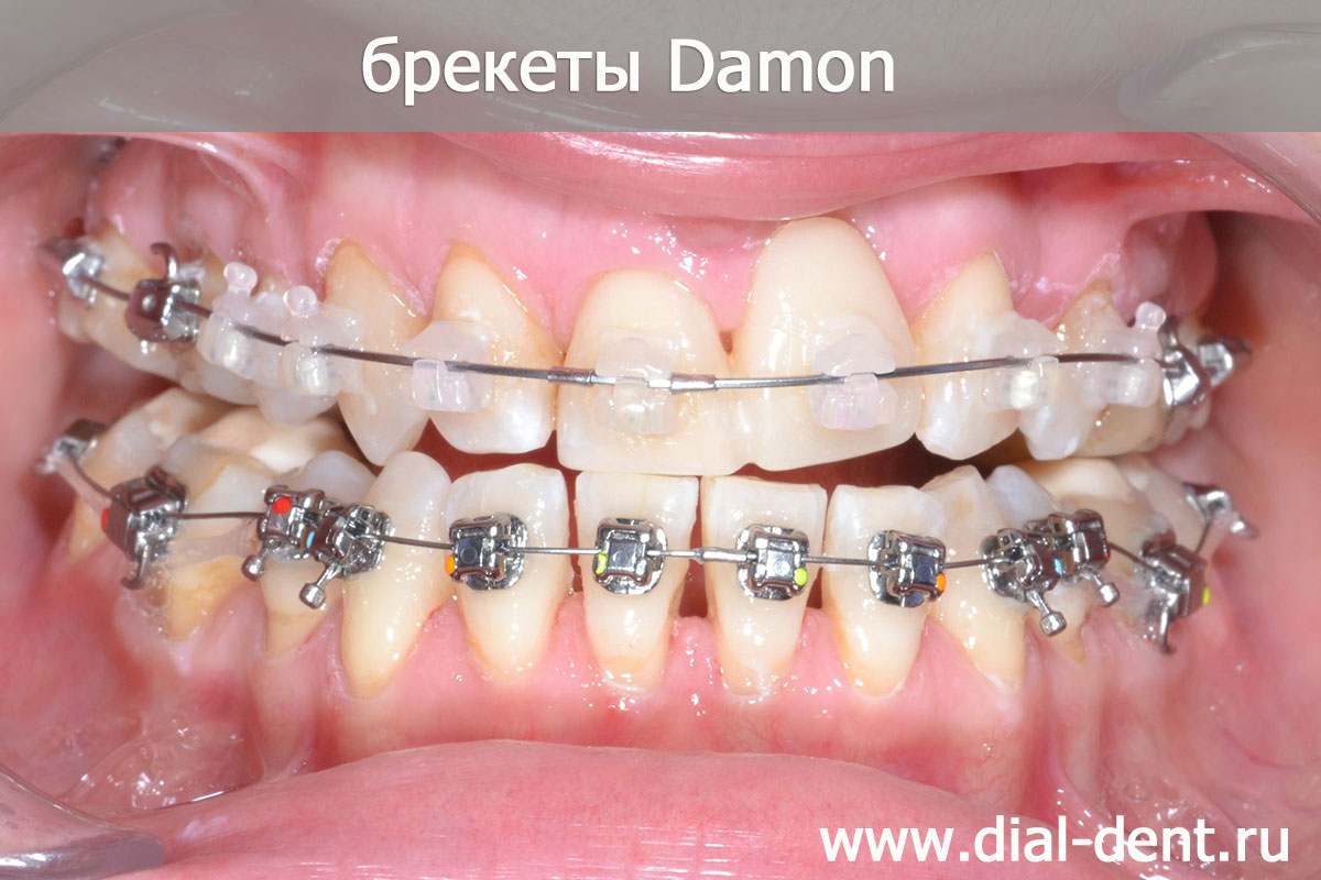 ортодонтическое лечение брекетами Damon