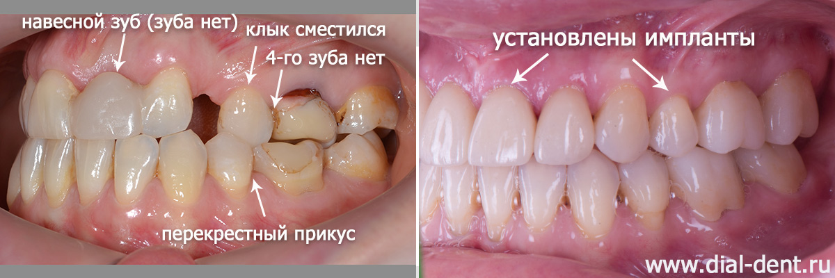 вид зубов слева до и после комплексного лечения в Диал-Дент
