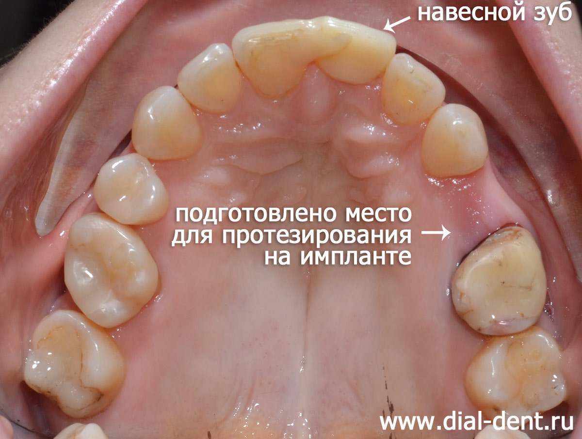 ортодонтическая подготовка к протезированию завершена