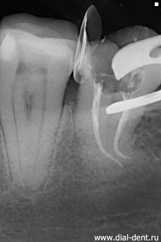 рентген зуба для контроля пломбировки каналов