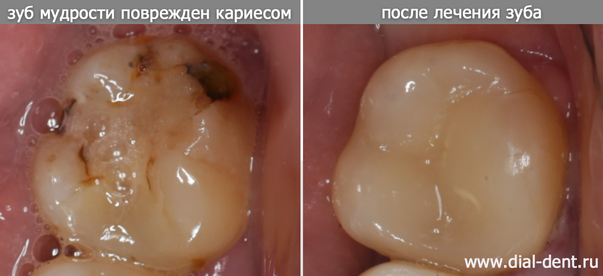 зуб мудрости до и после лечения