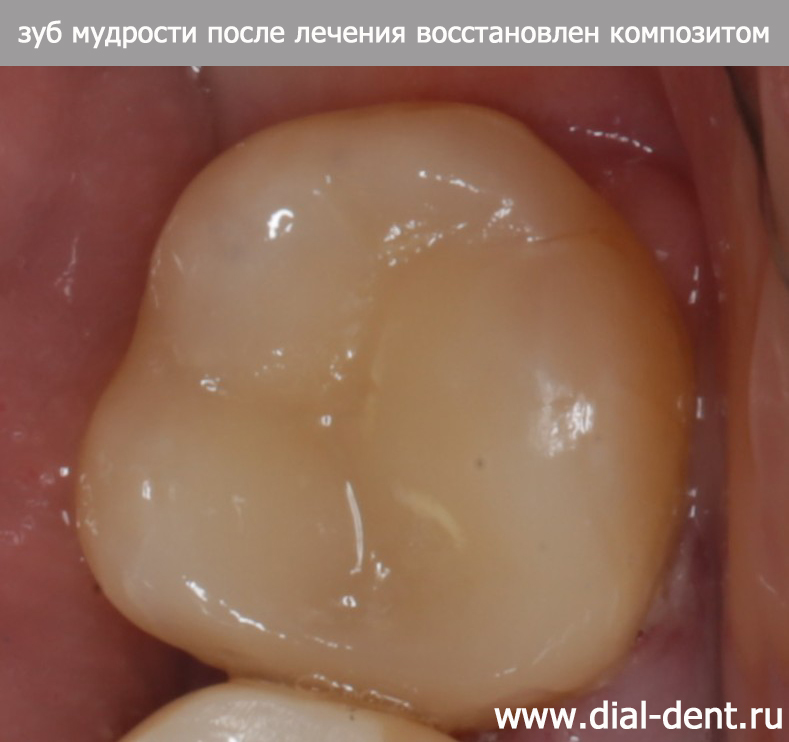 зуб мудрости после лечения восстановлен композитом