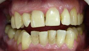 вид до процедуры отбеливания зубов