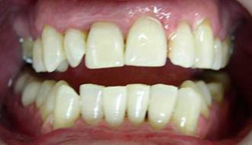 вид после процедуры отбеливания зубов