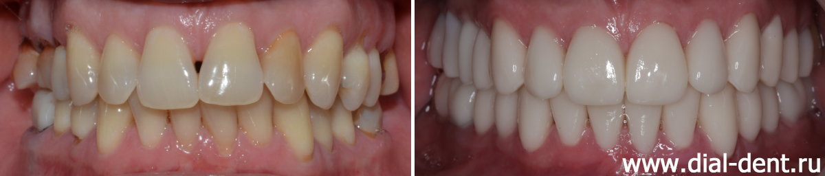 вид зубов до и после протезирования с комплексной подготовкой