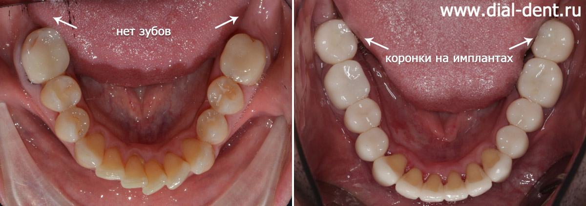 вид нижних зубов до и после протезирования