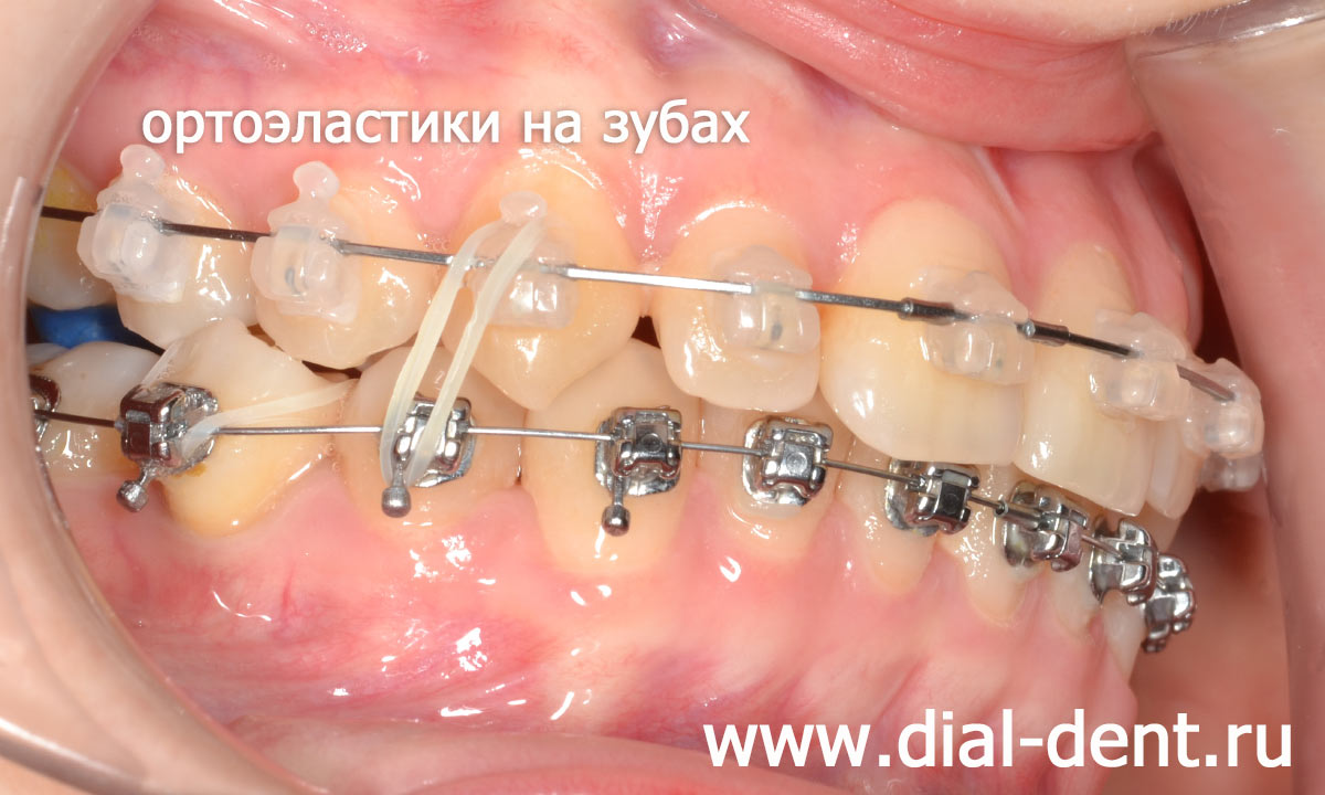 ортоэластики формируют правильные контакты между зубами