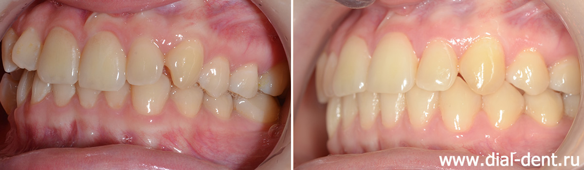 до и после ортодонтического лечения