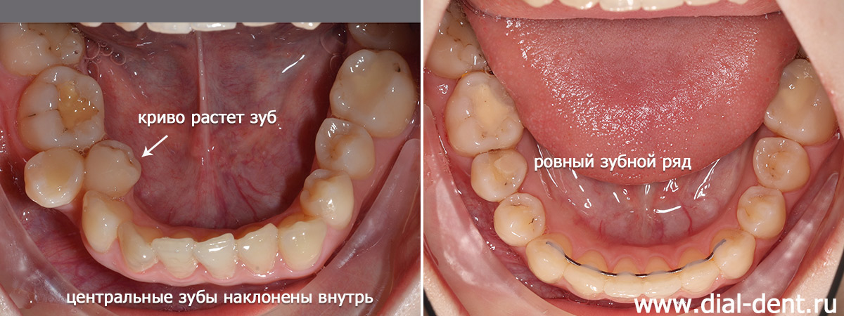 нижние зубы до и после ортодонтического лечения