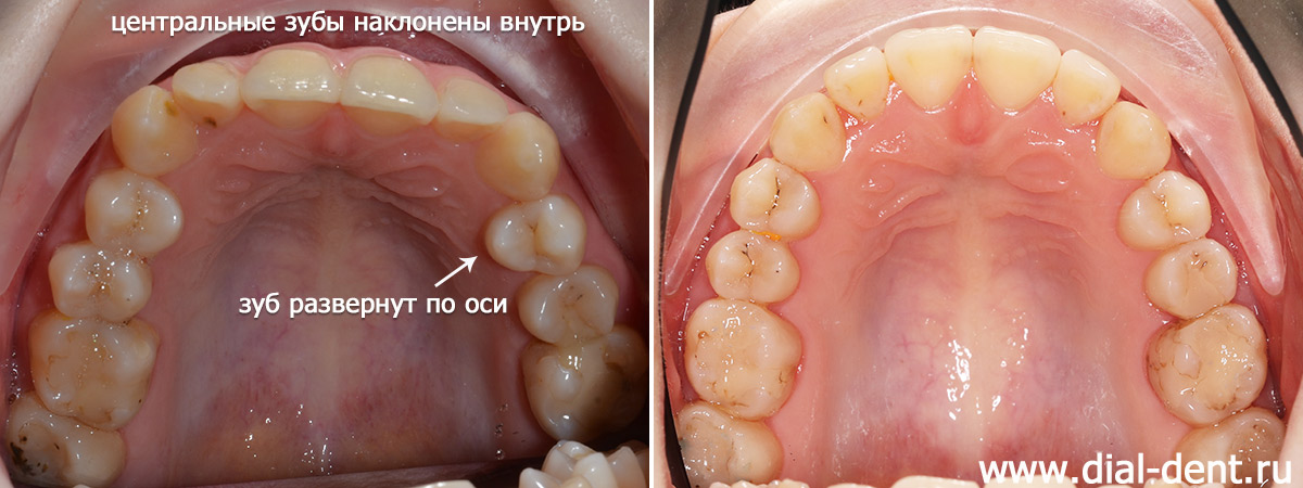 верхние зубы до и после ортодонтического лечения