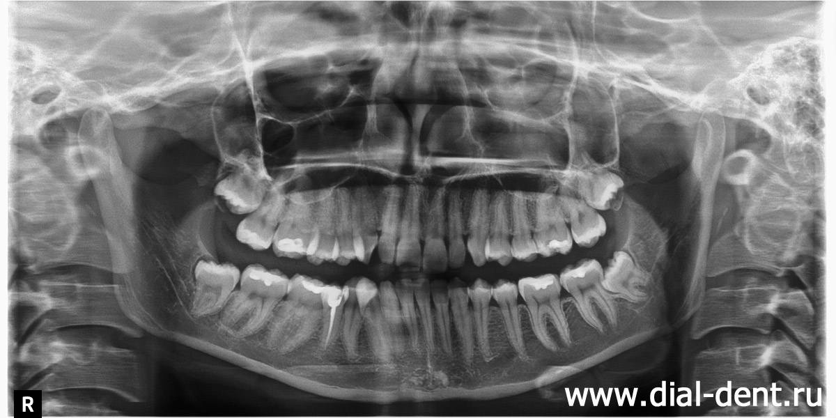 панорамный снимок зубов до начала лечения