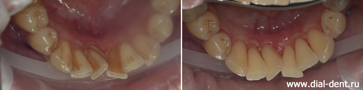 внутренняя поверхность нижних зубов до и после работы гигиениста