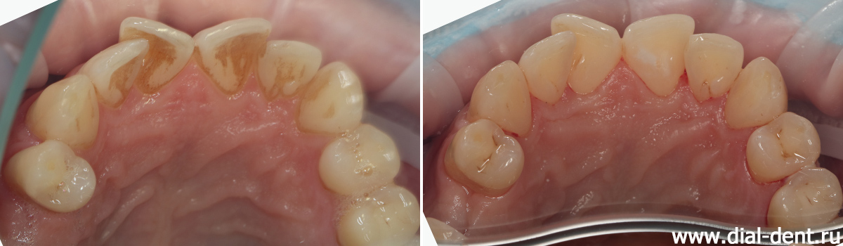 внутренняя поверхность верхних зубов до и после работы гигиениста