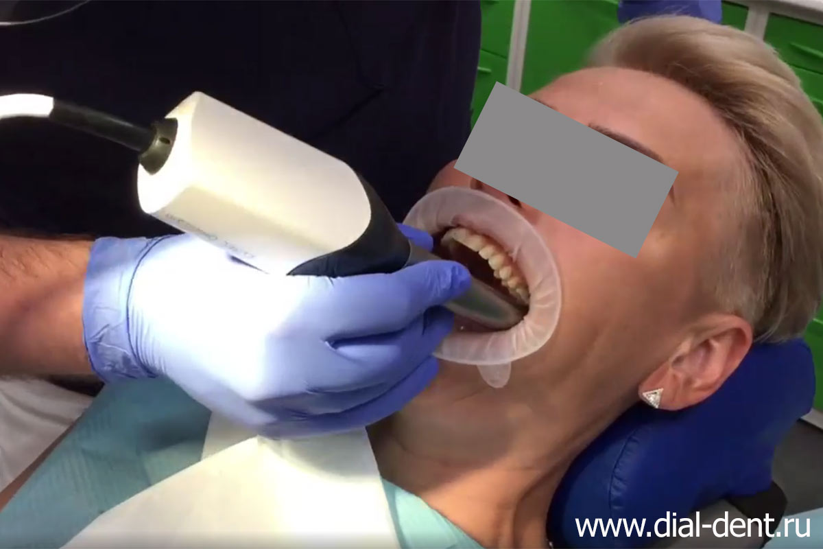 сканирование зубов для получения цифрового слепка