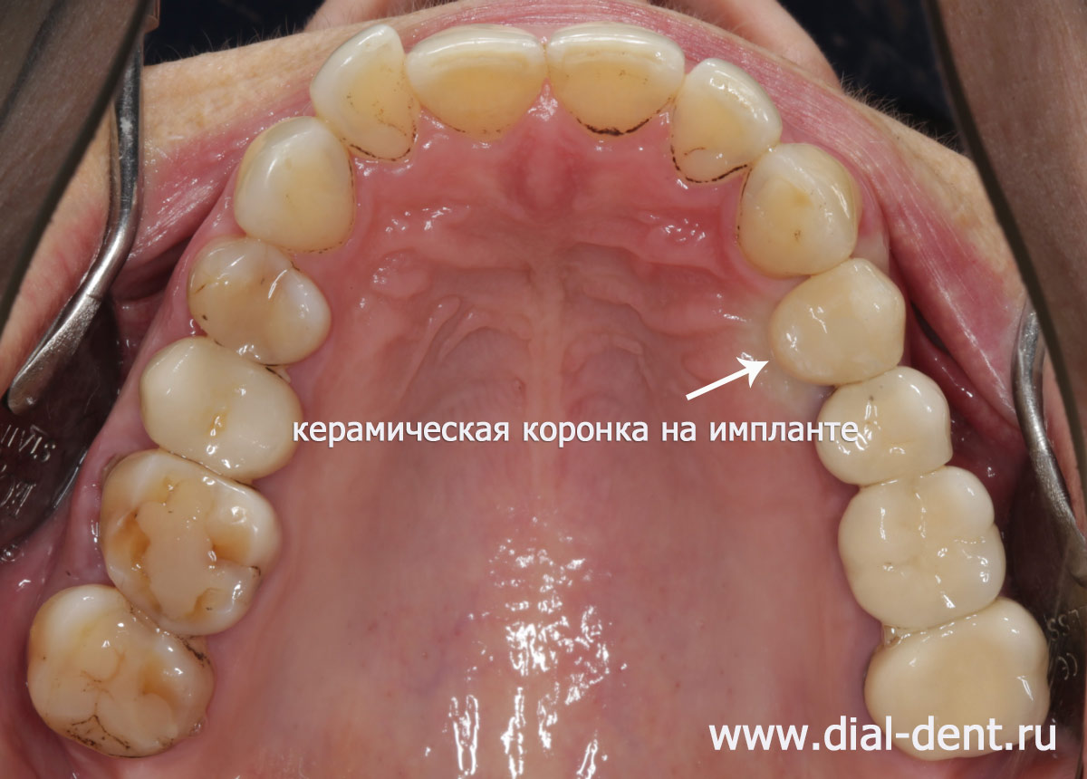 результат протезирования зуба керамической коронкой на импланте