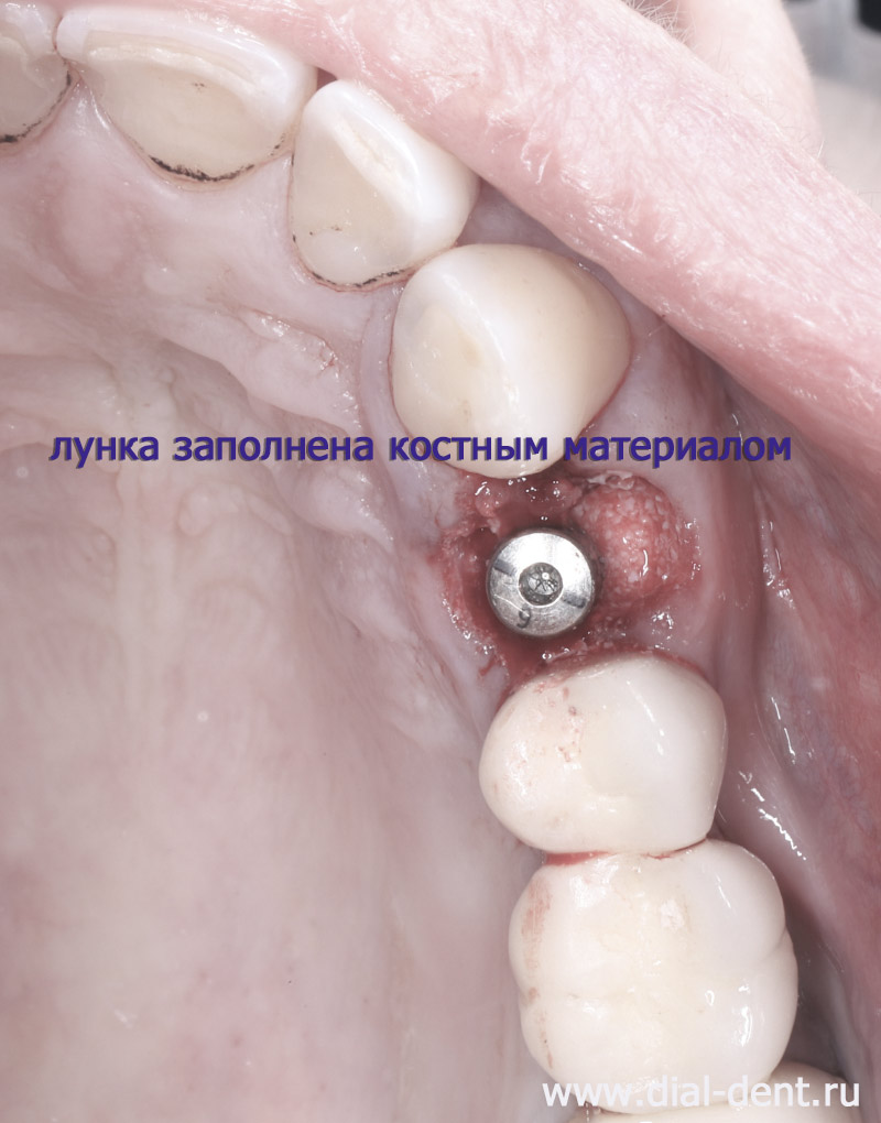 костная пластика и установка зубного импланта