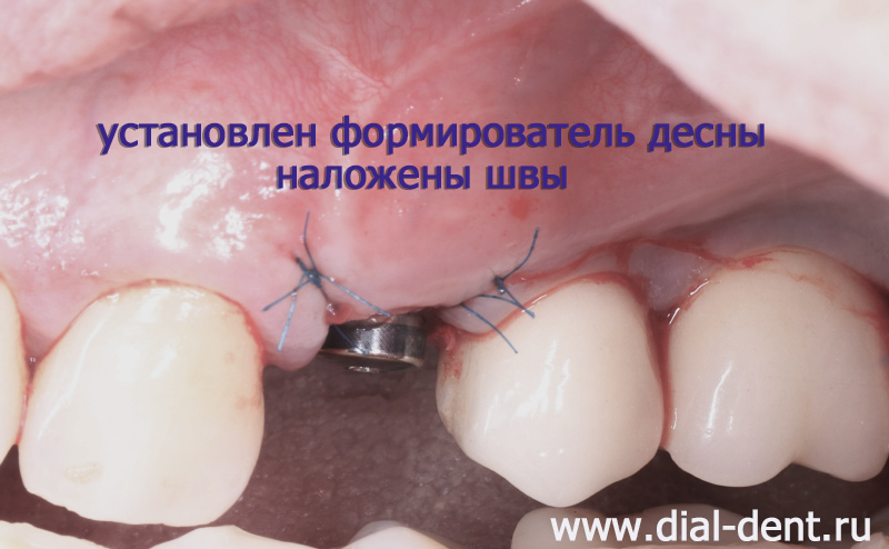вид сразу после удаления зуба, костной пластики, пластики мягких тканей и имплантации