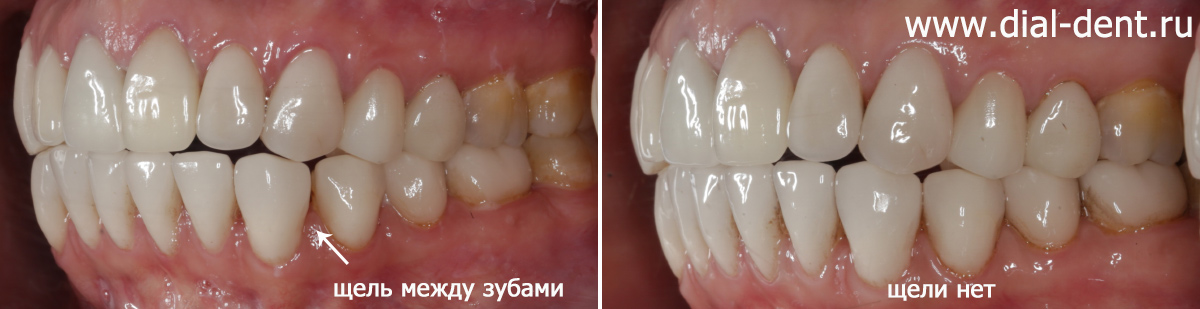 зубы до и после лечения