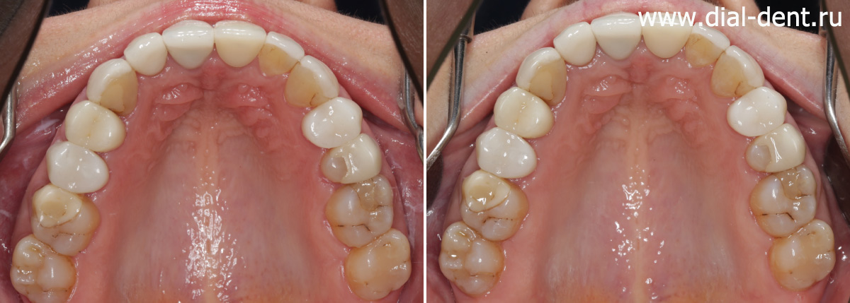верхние зубы до и после лечения