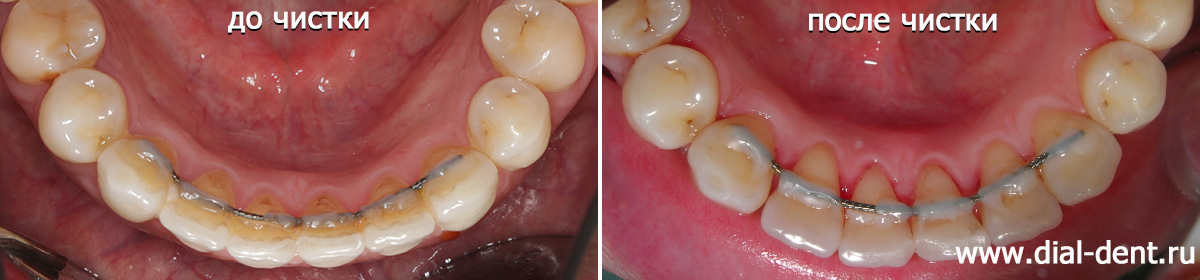 до и после чистки зубов