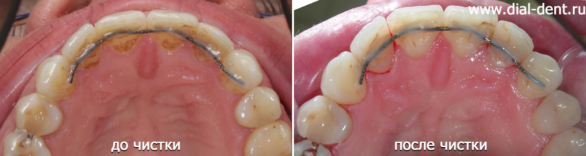 зубы после профессиональной чистки