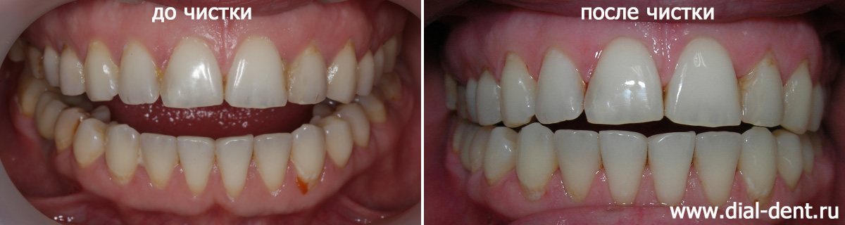 зубы до и после чистки