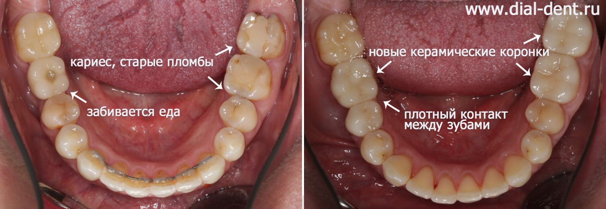 нижние зубы до и после реставрации