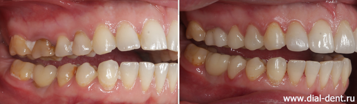до и после реставрации зубов вид справа